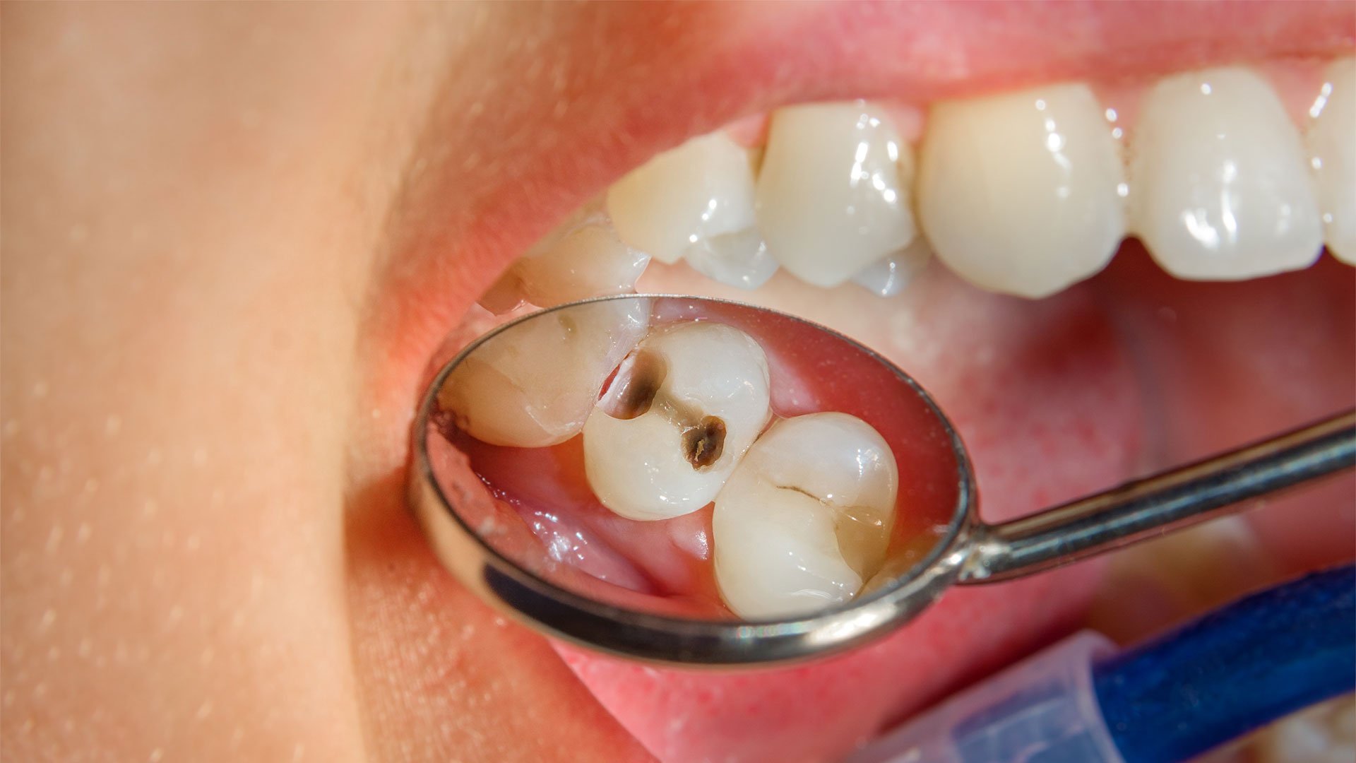 Dentista scopre con specchietto carie interdentale in paziente